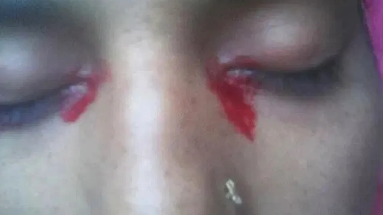 Femeia care plânge lacrimi de sânge: Ce tratament i-au administrat medicii