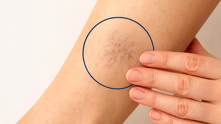 (P) Venele Păianjen (Telangiectaziile): Problemă estetică sau afecțiune vasculară?