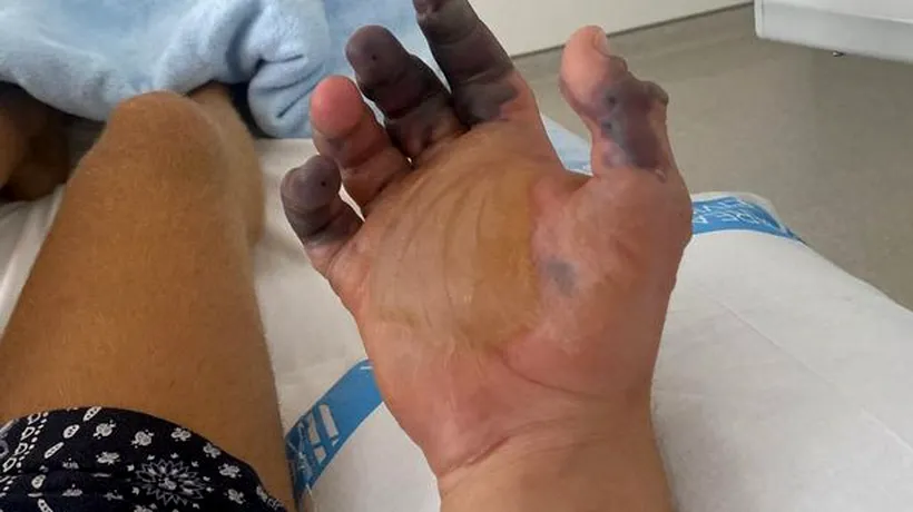 Un turist a rămas fără două degete după ce a fost mușcat de un păianjen, la Ibiza