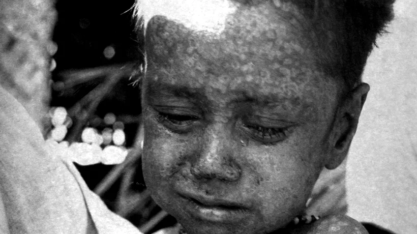 SUA: Alertă din cauza unei boli rare extrem de infecțioase. Ce este și cum se manifestă „variola maimuței”