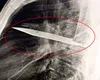 Consecințele unei bătăi de stradă. Un tanzanian a trăit opt ani cu o lamă de CUȚIT în piept