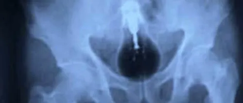 Cele mai ciudate lucruri pe care doctorii le-au găsit în stomacul pacienților. GALERIE FOTO