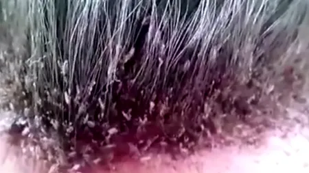 Reziști să vezi clipul până la final? Cel mai grav caz de infestare cu păduchi 