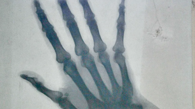 Radiografia mâinii drepte a reginei Elisabeta, vândută la licitație pentru 800 de euro