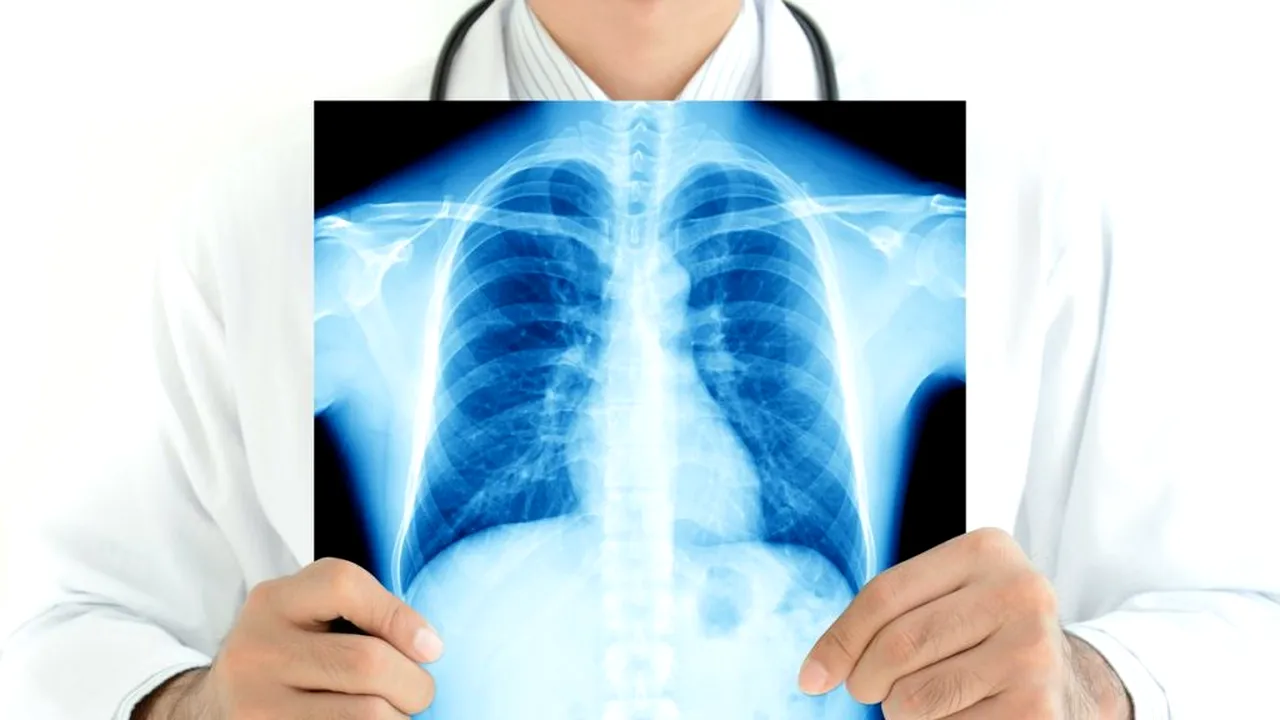 Coronavirusul, viteză de „autostradă” în organismul uman. Cum arată radiografia pulmonară a unei tinere infectate