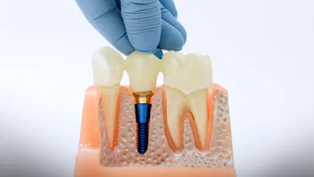 (P) De ce trebuie înțeles în context, nu izolat costul cu coroana pentru dinte