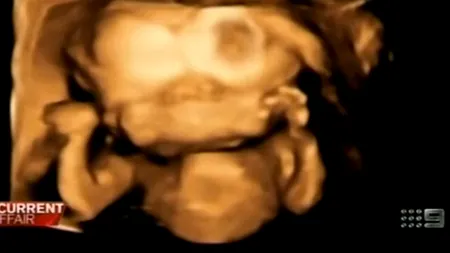 FOTO: Ce a descoperit un cuplu când s-a uitat mai bine la ecografia cu ''gemenii'' pe care îi așteptau