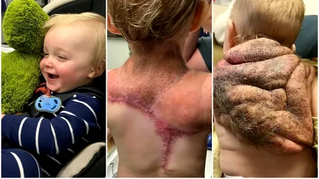 Un băiețel s-a născut cu o ”carapace” pe spate. Părinții nu au știut ce să facă când au văzut cum arată copilul lor