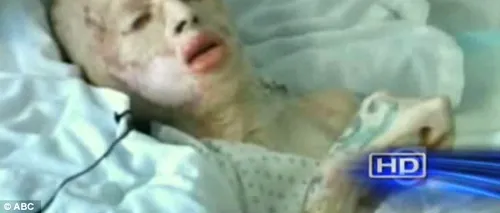 VIDEO. Mărturie cutremurătoare de pe patul de moarte a unui tânăr care în urmă cu 13 ani a fost ars de viu