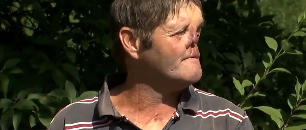 Mărturia cutremurătoare a bărbatului desfigurat de urs și operat de 80 de ori: „Mi-a mușcat fața”