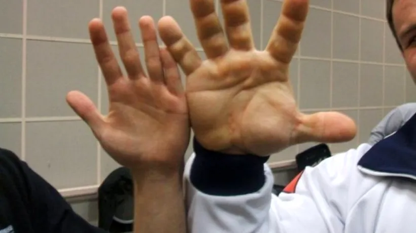 Cum arată omul cu cele mai mari mâini: „E o ciudățenie a naturii. VIDEO