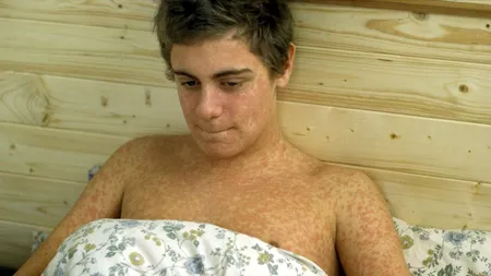 Rujeola a început să-i ucidă și pe părinții NEVACCINAŢI. Un bărbat de 41 de ani, nevaccinat, care a luat boala de la fiul său, a decedat