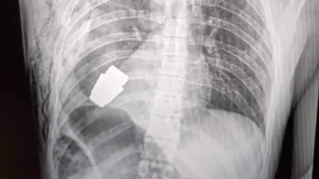 Grenadă neexplodată, extrasă din corpul unui soldat ucrainean (FOTO)