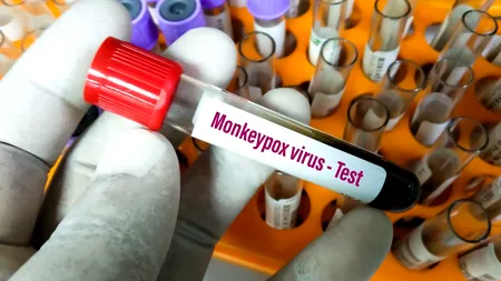 OMS: „Variola maimuței nu este noul COVID”. Totuși, ONU solicită un răspuns global coordonat