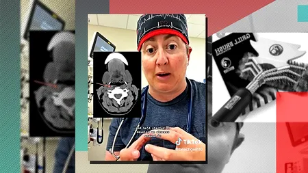 VIDEO | Ce a găsit un medic în gâtul unui copil care mâncase un hamburger: „Nu aveam idee ce se întâmplă cu el”