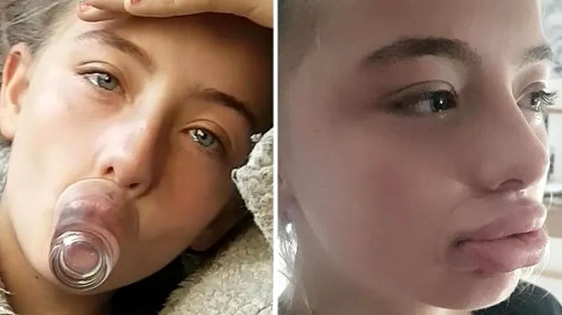 O fată de 12 ani și-a „distrus buzele după ce a încercat provocarea lui Kylie Jenner