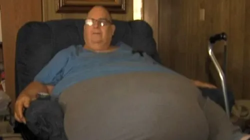 Un bărbat are o tumoră gigantică, de 90 de kilograme, pe abdomen