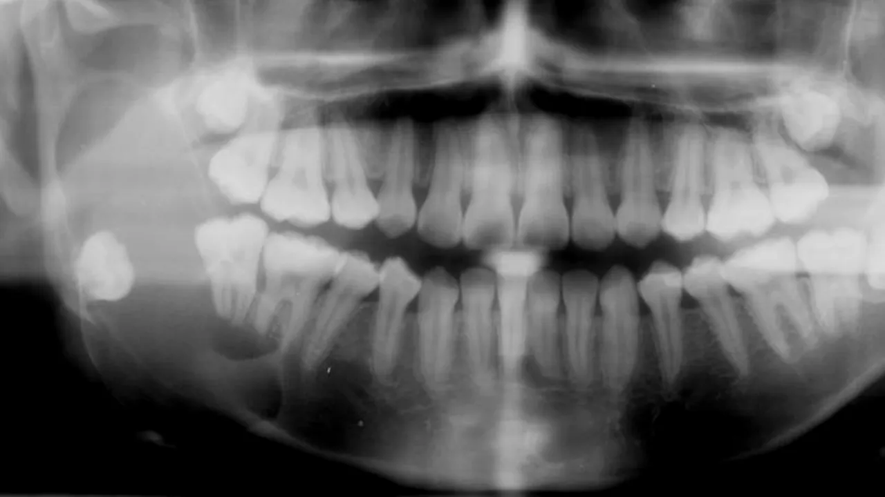 Cât de sigure sunt radiografiile dentare