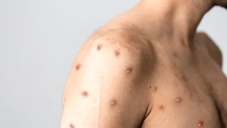 România a ajuns la 14 cazuri de variola maimuței, după diagnosticarea a încă trei pacienți. Care este starea acestora