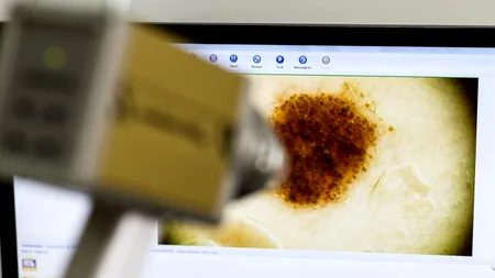 Incidența cancer cutanat