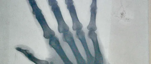 Radiografia mâinii drepte a reginei Elisabeta, vândută la licitație pentru 800 de euro