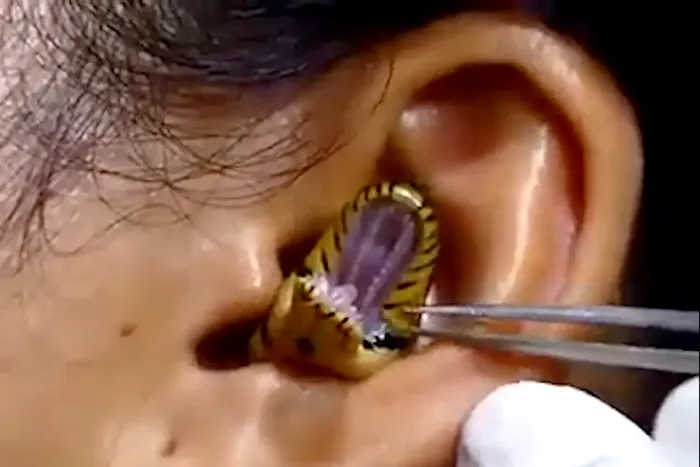 VIDEO | Imagini bizare: Un „chirurg” scoate un șarpe viu din urechea unei femei / Filmarea a ajuns virală / Sursa foto: NY Post via Facebook/Chandan Singh