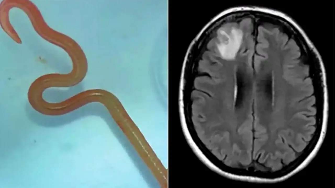 Un vierme, care sălășuiește de obicei în pitoni, s-a aciuit în creierul unei femei din Australia. De unde poate proveni parazitul buclucaș