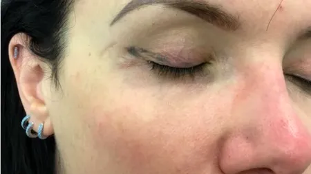 „Mi-a distrus fața. A fost îngrozitor de dureros!