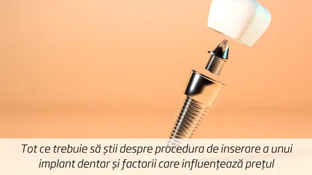 (P) Tot ce trebuie să știi despre procedura de inserare a unui implant dentar și factorii care influențează prețul