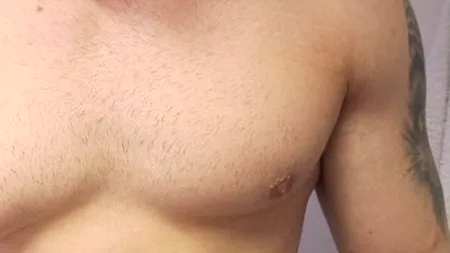 Afecțiunea rară de care suferă acest bărbat. 