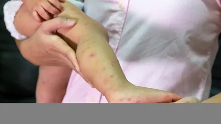 Alte 109 de cazuri de rujeolă au fost înregistrate în ultima săptămână în România