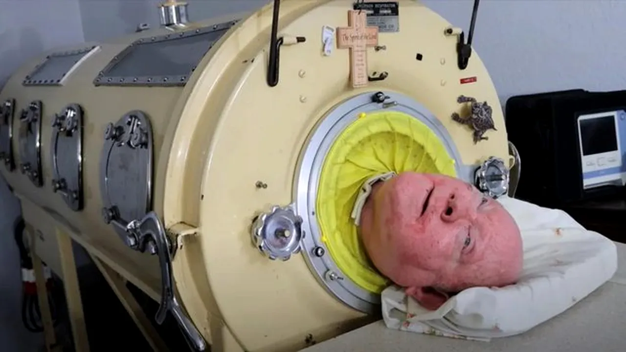 Paul Alexander, bărbatul care a trăit mai bine de 70 de ani într-un „plămân de fier”, a MURIT la vârsta de 78 de ani