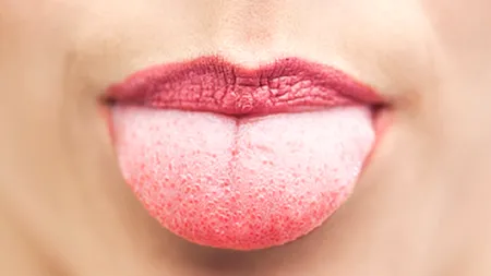 Limba îți poate arăta de ce boli suferi