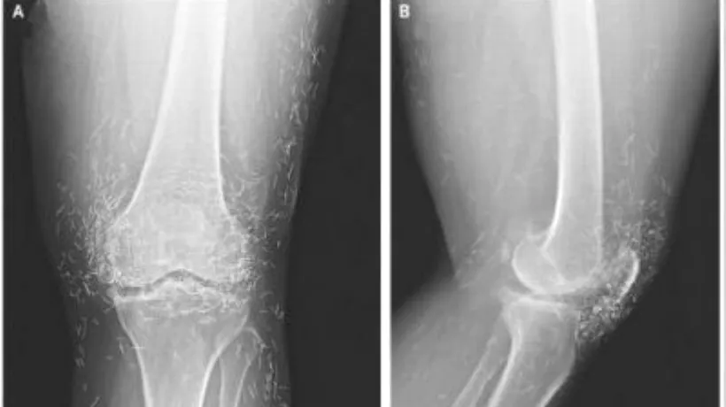 Descoperire facută după o radiografie: Femeia are o comoară în genunchi. Anunțul făcut de medici