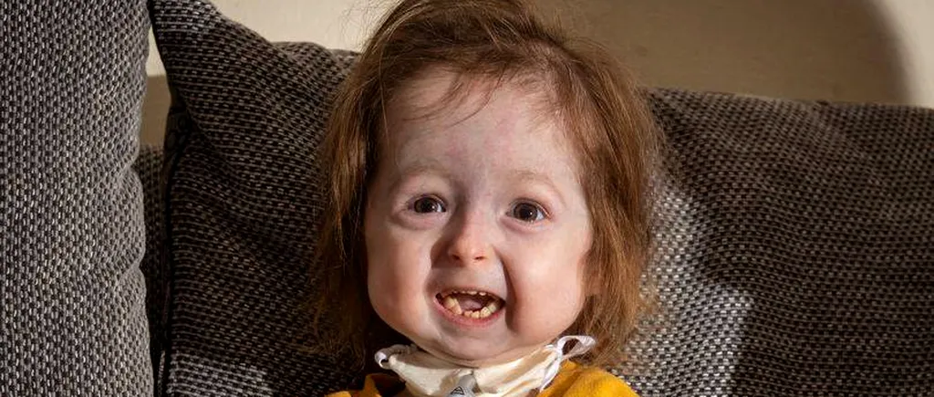 Fetiță de doi ani, singurul pacient din lume care suferă de boala prezentată în filmul „Benjamin Button. Maladia i-a provocat o îmbătrânire prematură a organismului 