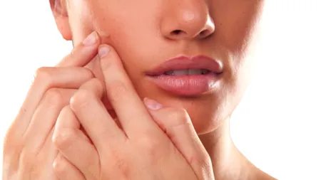 De ce mai ai coșuri la 30 de ani