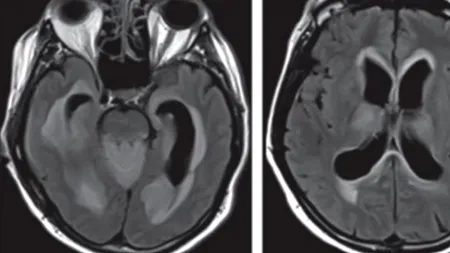Un bărbat a ajuns la spital cu o infecție misterioasă. Ce au descoperit medicii abia după moartea pacientului
