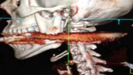 Caz inedit. O femeie a supraviețuit după ce soțul ei i-a străpuns fața cu un harpon