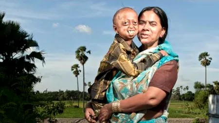Povestea adolescentului care suferă de boala care afectează un om din patru milioane. 