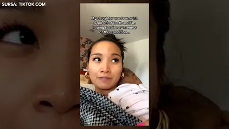 Caz INEDIT. Un bebeluș s-a născut cu dantura completă. Cum arată micuța și ce spun medicii