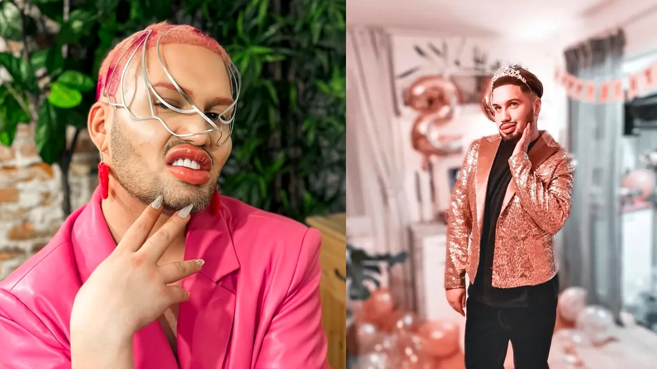 A cheltuit 90.000 euro pe 100 de operații estetice, inspirat de Michael Jackson: „Vreau să am cele mai mari buze din lume”