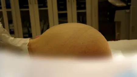 O tumoare de 23 kg, extirpată din abdomenul unei femei din Bulgaria