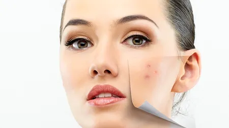 De ce nu scăpăm de acnee după adolescență