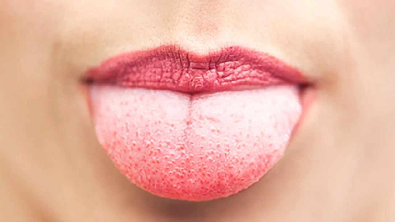 „Dacă observați asta pe limba dumneavoastră, mergeți imediat la medic!