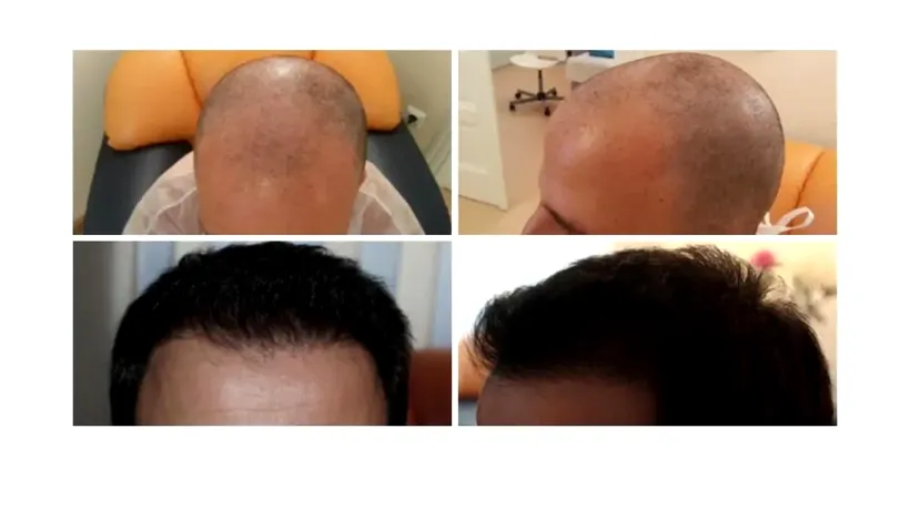 (P) Cum scapi de alopecie? Află aici informații despre implantul de păr și tehnica Q-FUE