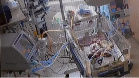 Medicii nu știu ce să facă pentru siamezele născute înainte de Crăciun. De ce este cazul unic în lume