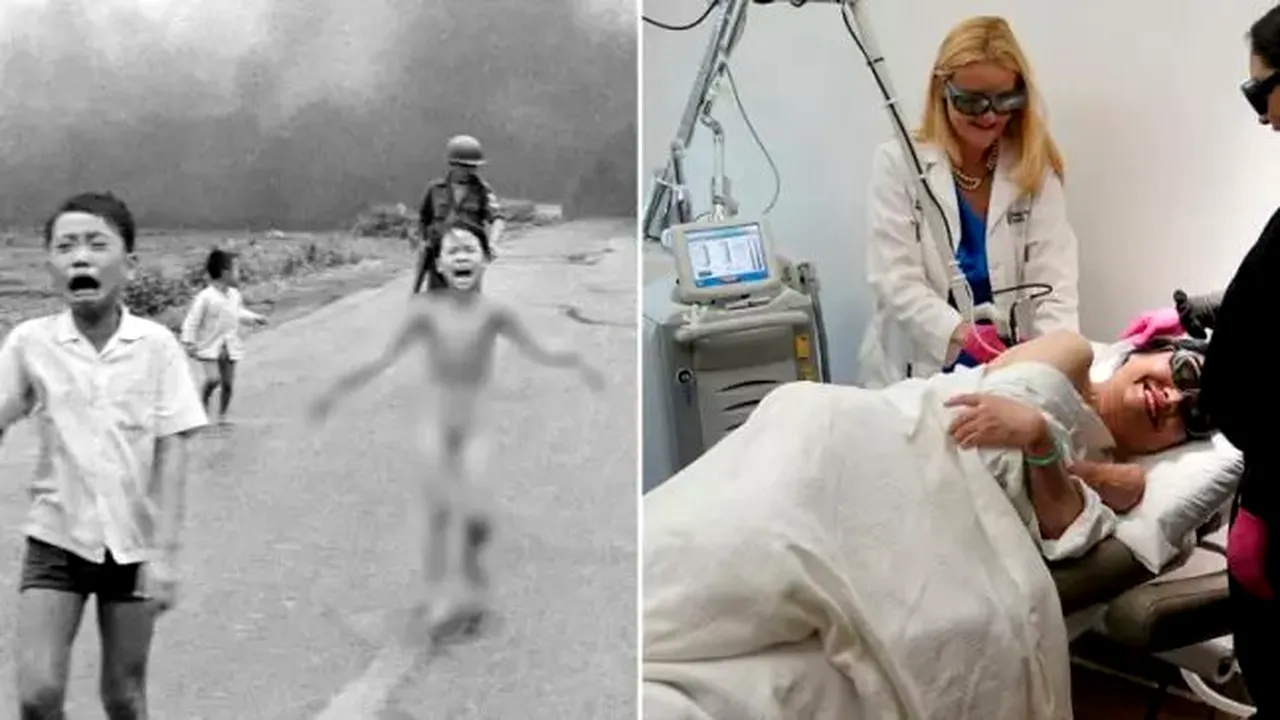 ”Fetița Napalm” din Vietnam a făcut ultimul tratament de piele la 59 de ani. Care este povestea ei