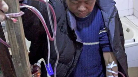 Un chinez a făcut dializă folosind un aparat pe care l-a construit singur. FOTO