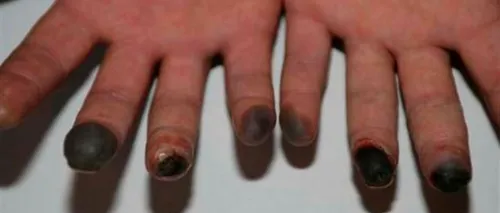 Caz unic în Germania: o femeie a suferit degerături în plină vară