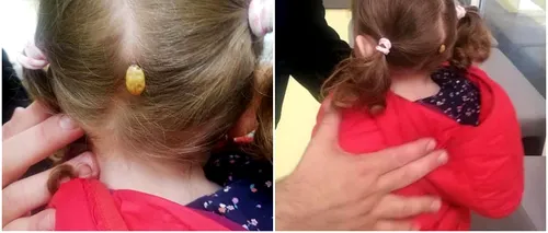 Căpușă uriașă descoperită pe scalpul unei fetițe din Suceava. Copilul a fost dus urgent la spital